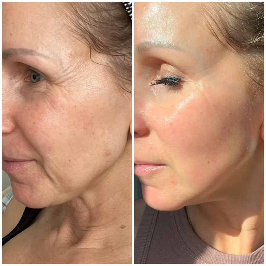 Skinbooster & Bioestímulo