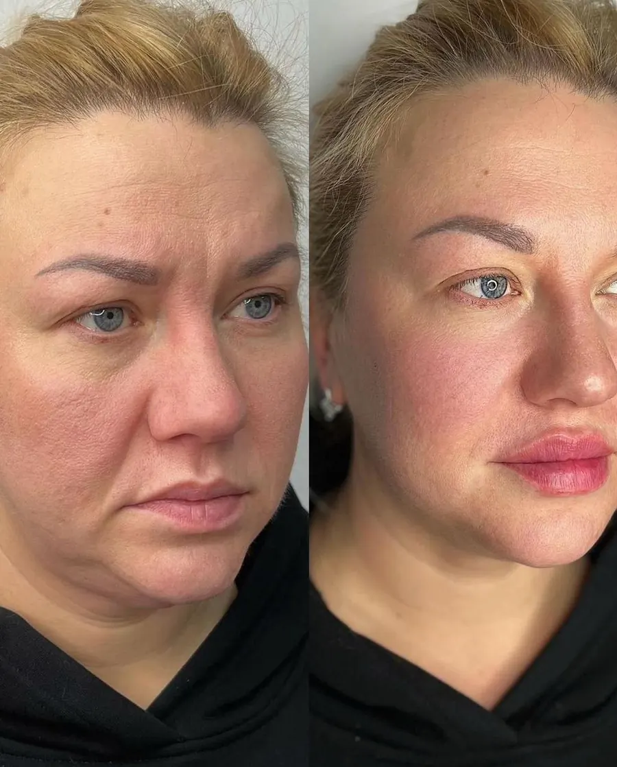 Bioestimulador Facial