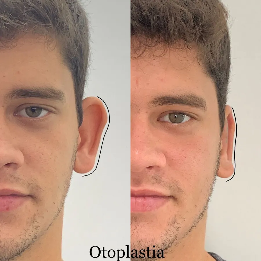 Otoplastia